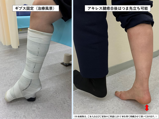 右アキレス腱断裂写真