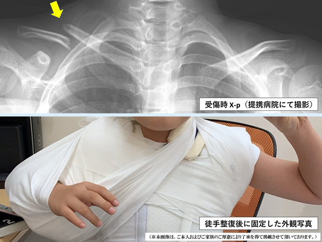 右鎖骨骨折写真