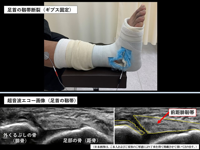 右前距腓靭帯断裂写真