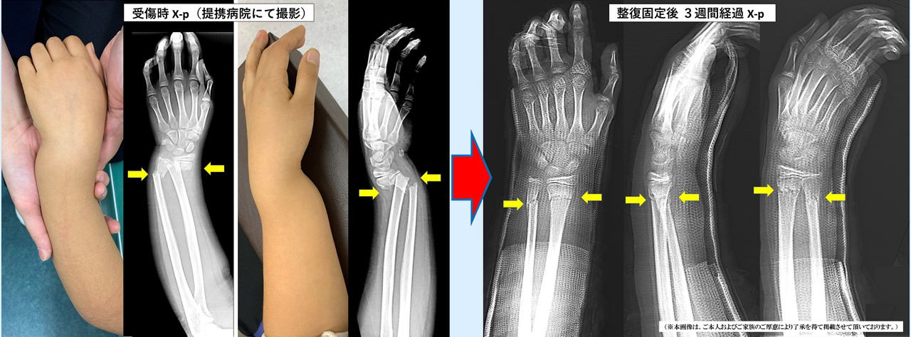 手首の左前腕両骨骨折写真