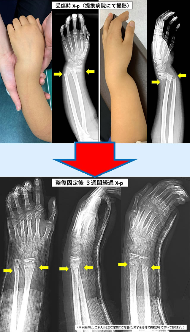 手首の左前腕両骨骨折写真