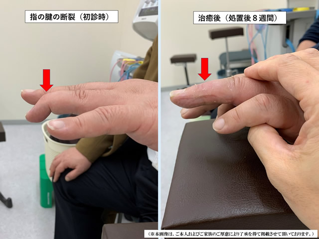 左第4指伸筋腱断裂写真